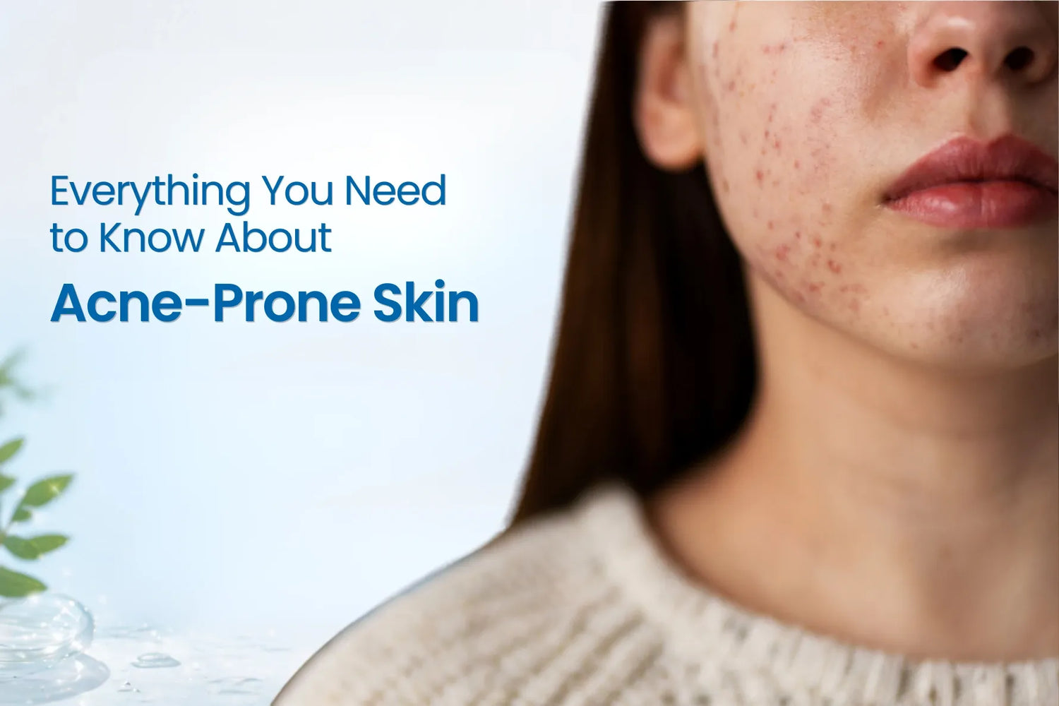 Acne-prone skin banner showing facial breakouts and about acne skincare guide